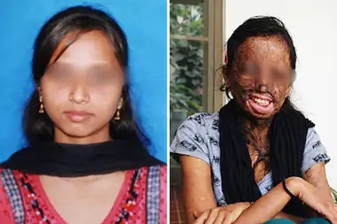 Help Priya Reclaim Her Life After a Brutal Acid Attack